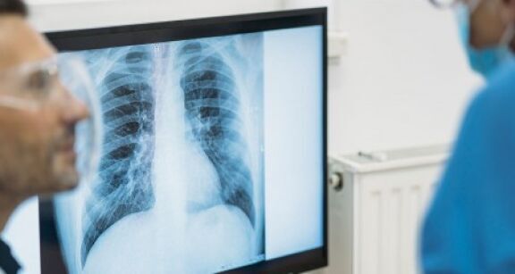 Vers un dépistage organisé du cancer du poumon ?